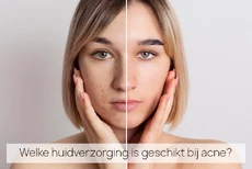 vrouw met links acné en rechts een huid zonder acné